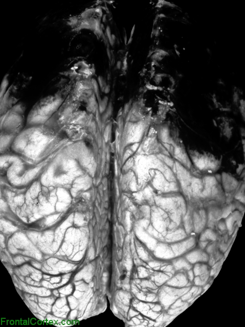 Bilateral hemorrhagic infarcts, dorsal surface of brain.
